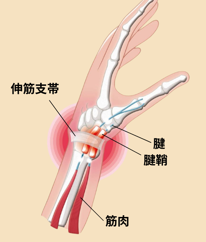 腱鞘炎 図解